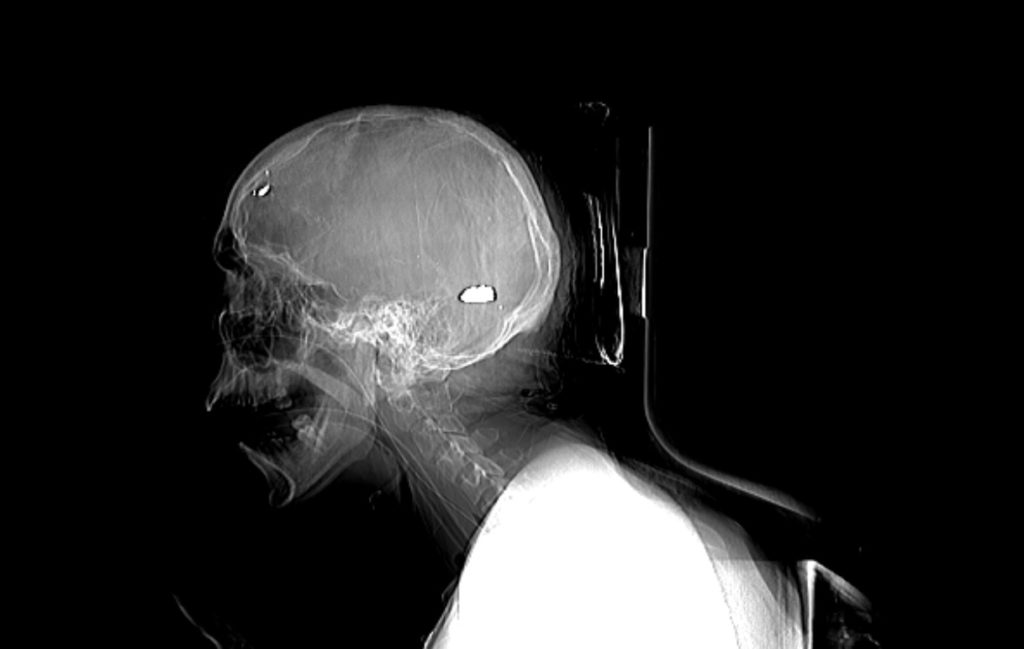 Disparo con trayectoria de arriba hacia abajo. Ingresó en la frontal-derecho hacia la región parieto-occipital. El proyectil de AK quedó alojado en la línea media del cerebro (Fuente: Confidencial).