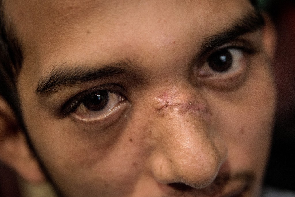 Juan Bosco Rivas Martínez muestra la cicatriz que le dejó la bala de AK que perforó su rostro. (Fuente: Confidencial)
